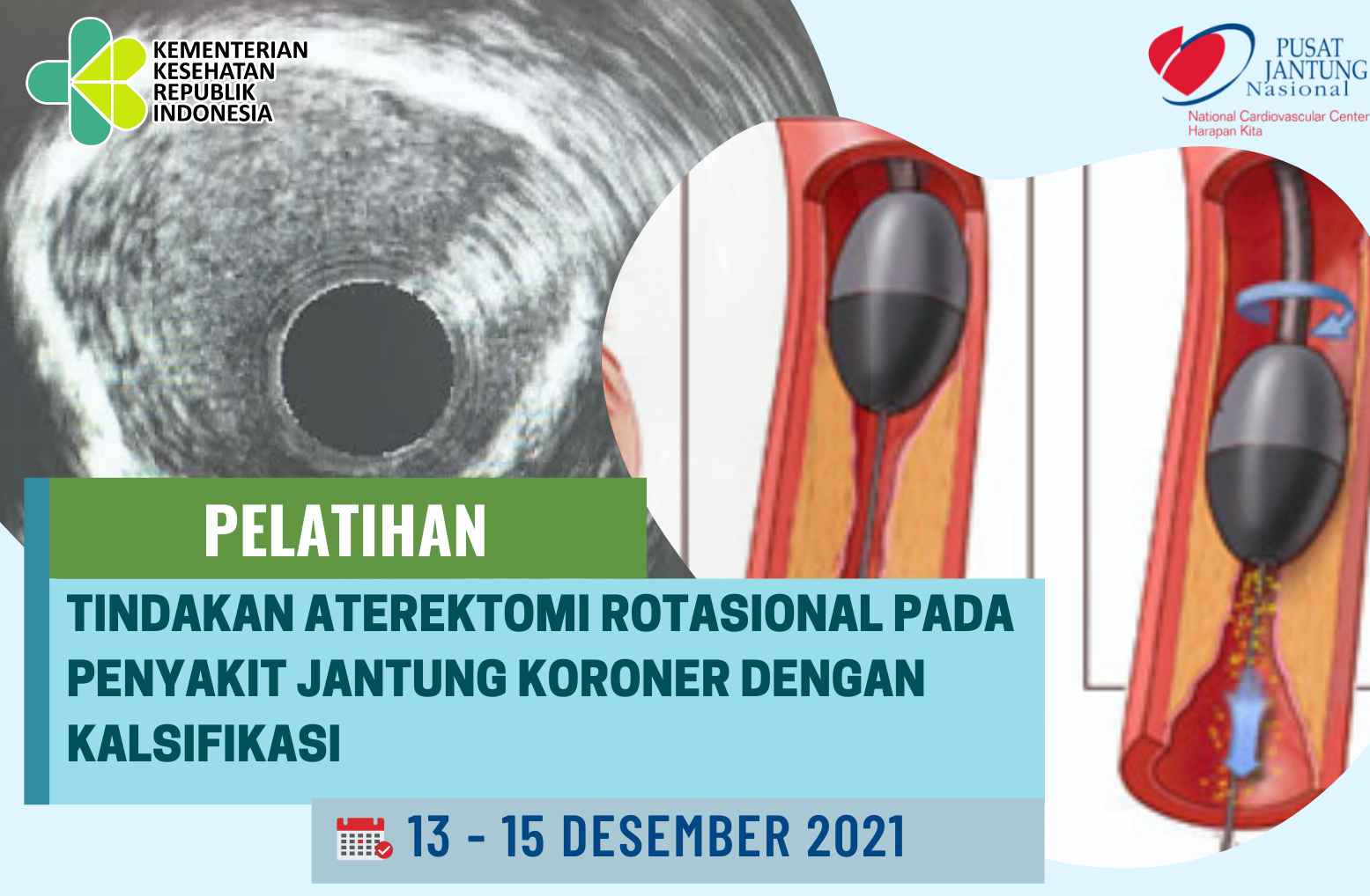 Tindakan Aterektomi Rotasional pada Penyakit Jantung Koroner dengan Kalsifikasi