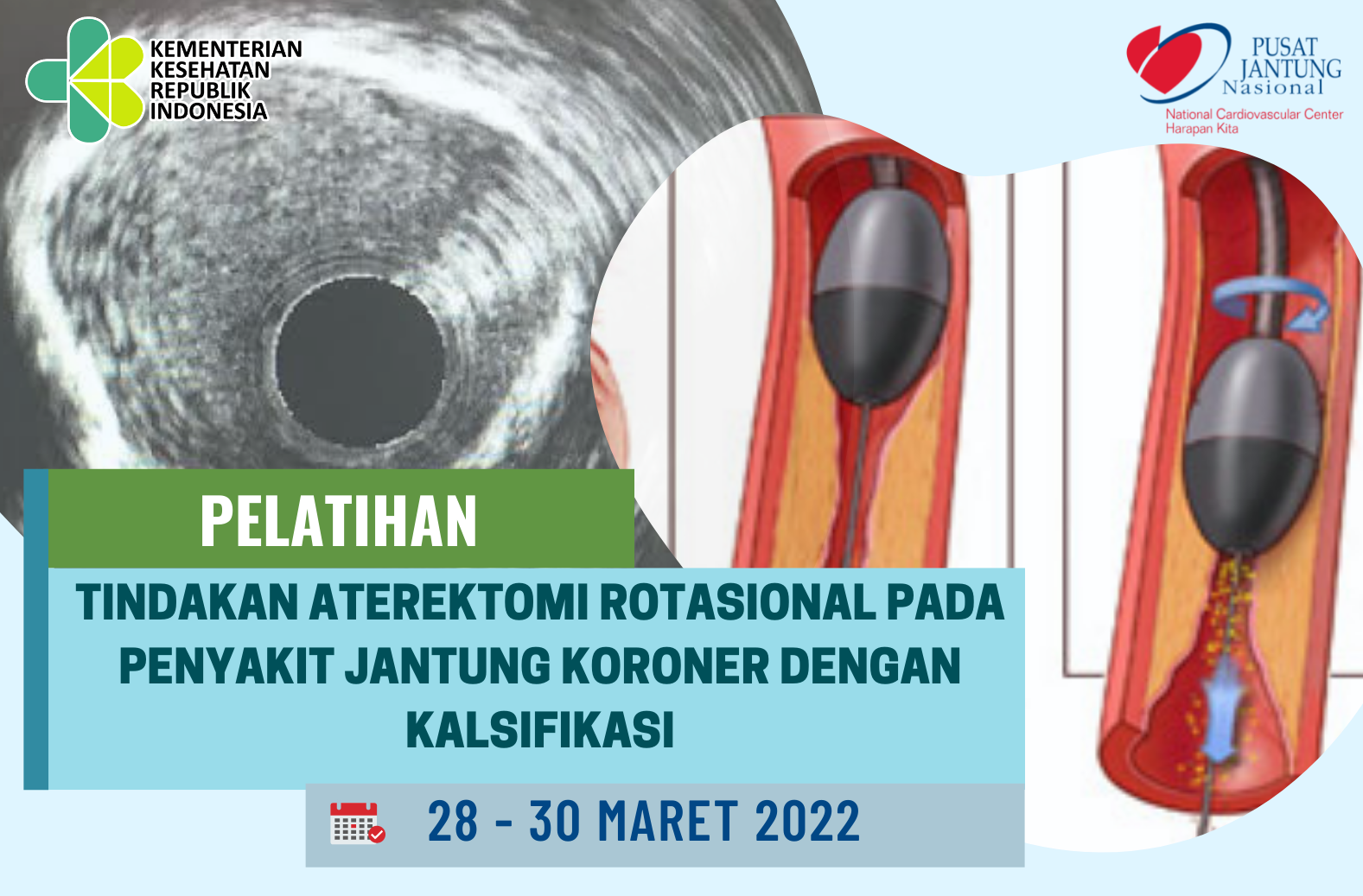 Tindakan Aterektomi Rotasional pada Penyakit Jantung Koroner dengan Kalsifikasi